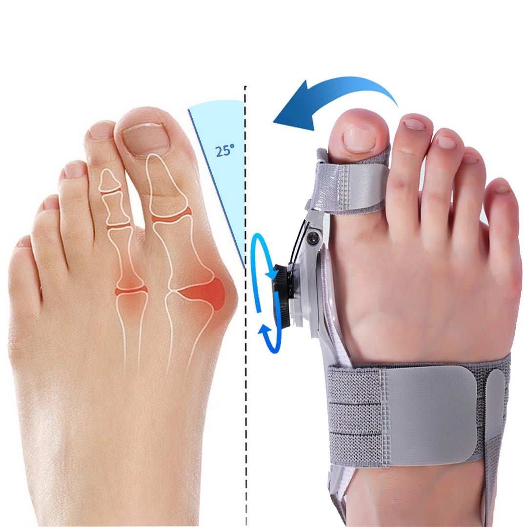 Hallux valgus vorher und nachher mit der HalluxFix Schiene